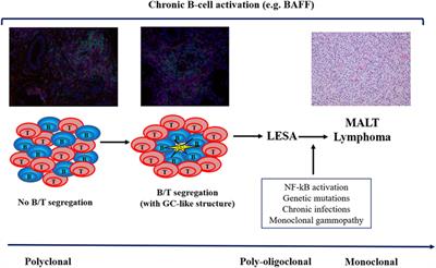 Lymphoma and Lymphomagenesis in Primary Sjögren’s Syndrome